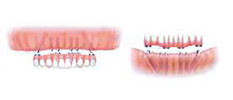 Full Jaw Dental Implants with All-on-4 Packages