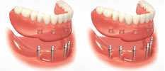 Mini Implants with Overdentures Mini Implants with Overdentures