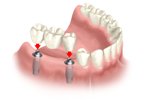 Multiple Dental Implants