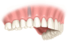 Single Dental Implant