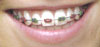 Metal braces