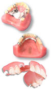 Removable Partial Dentures